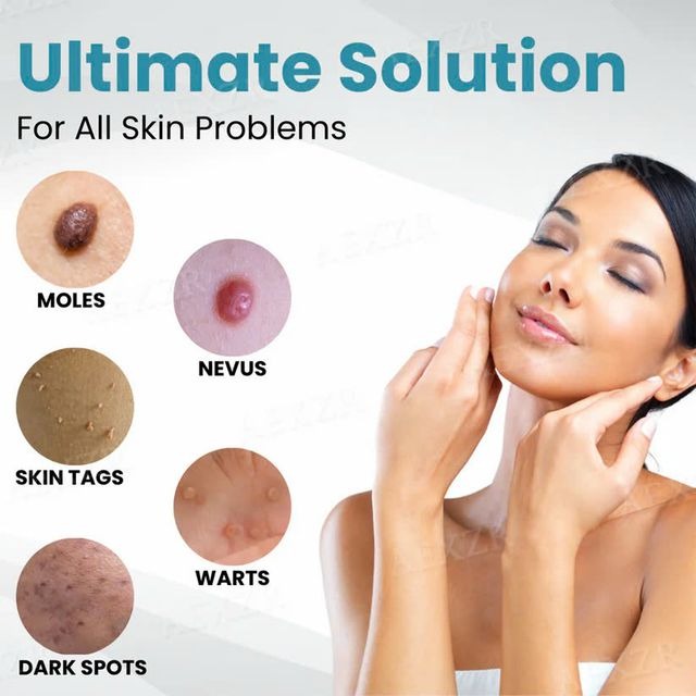 Non Invasive Mole and Wart Removal Pen